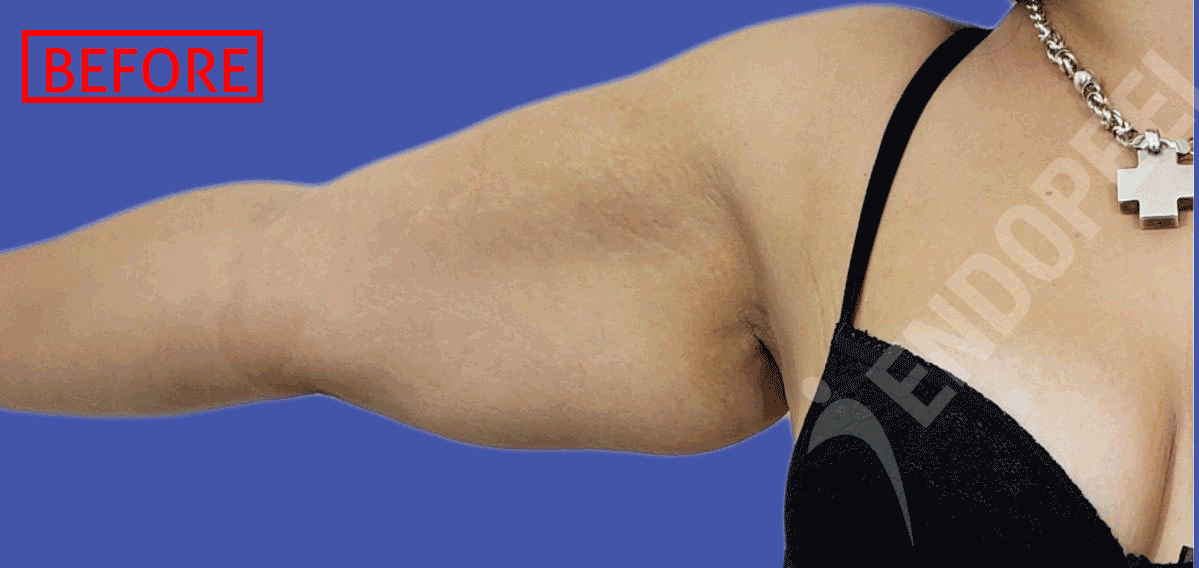 arm-lift-animated