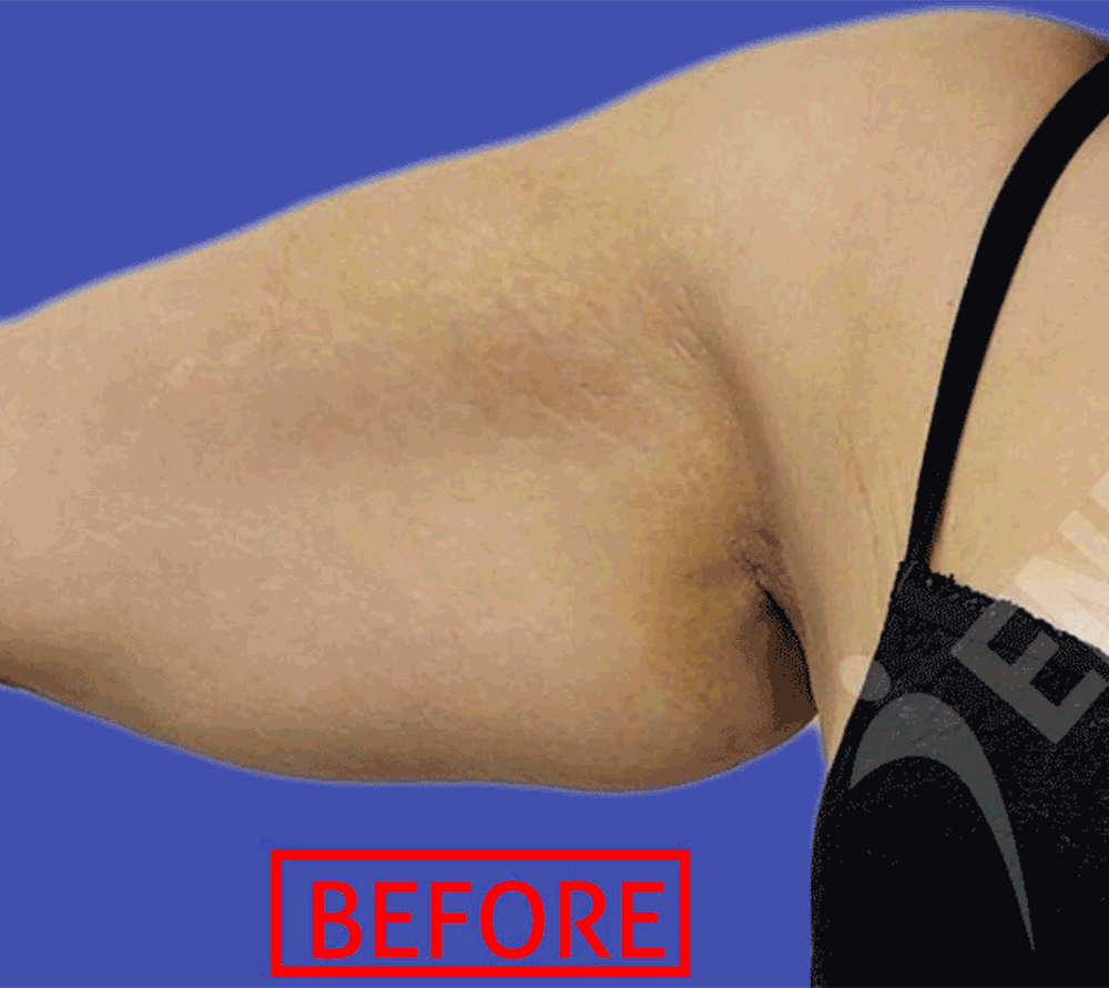 sagging-skin-upper-arms