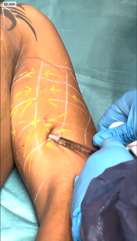 Step13-injections-of-tensors