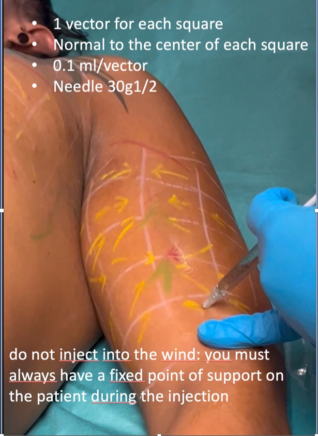  vector1-injection