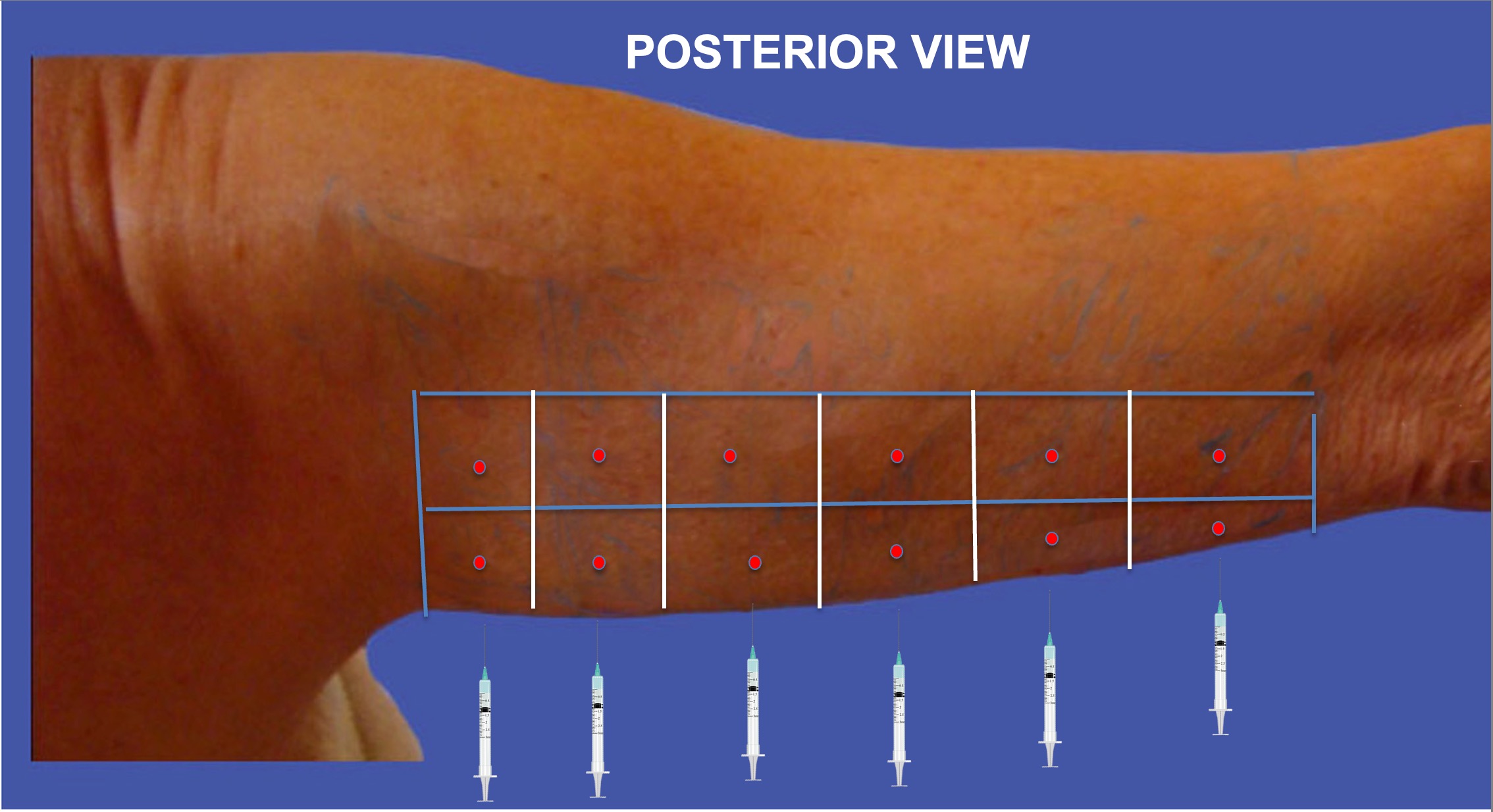 lower-edge-injections--posterior view