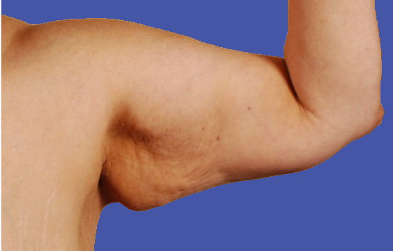 bulge-under-arm
