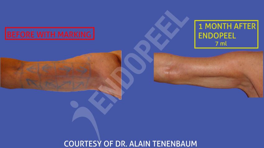 arm-lift-slide-2.jpg