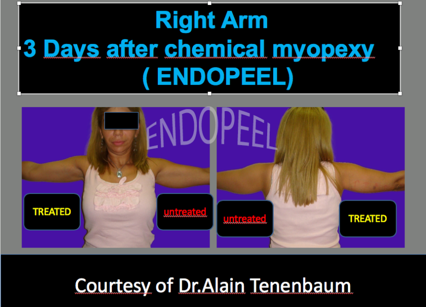 arm-lift-8.png
