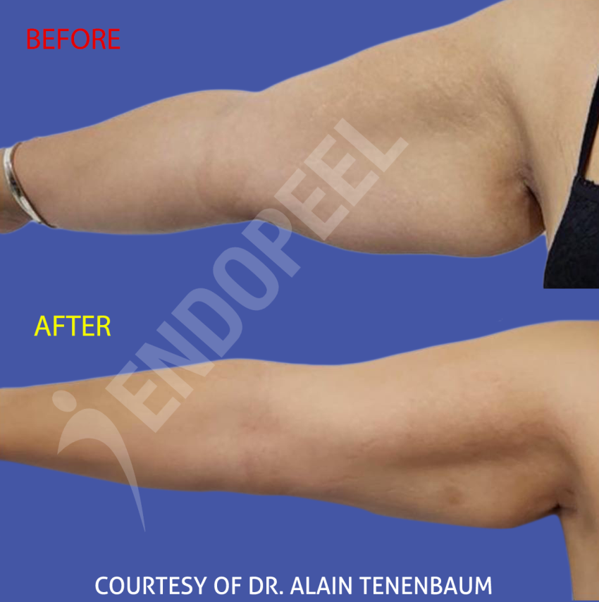 arm-lift-2-alain.png