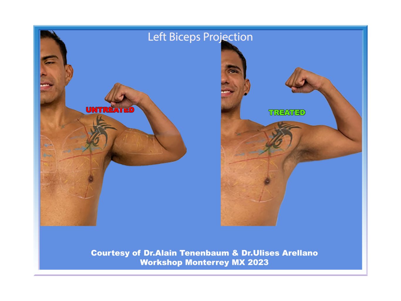 biceps-projection