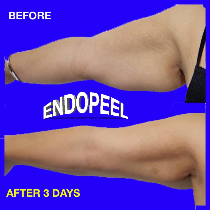 bingo-wings-endopeel-face-view.png